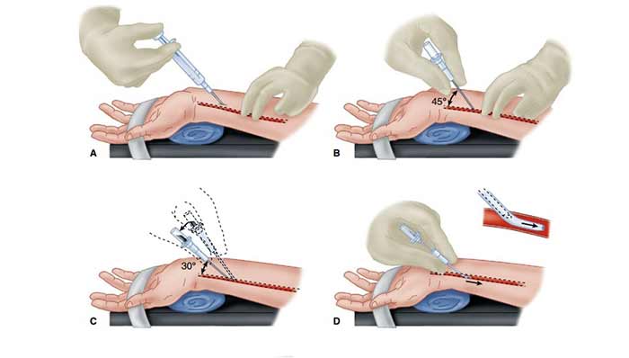IBP1 یا Invasive Blood Pressure 1